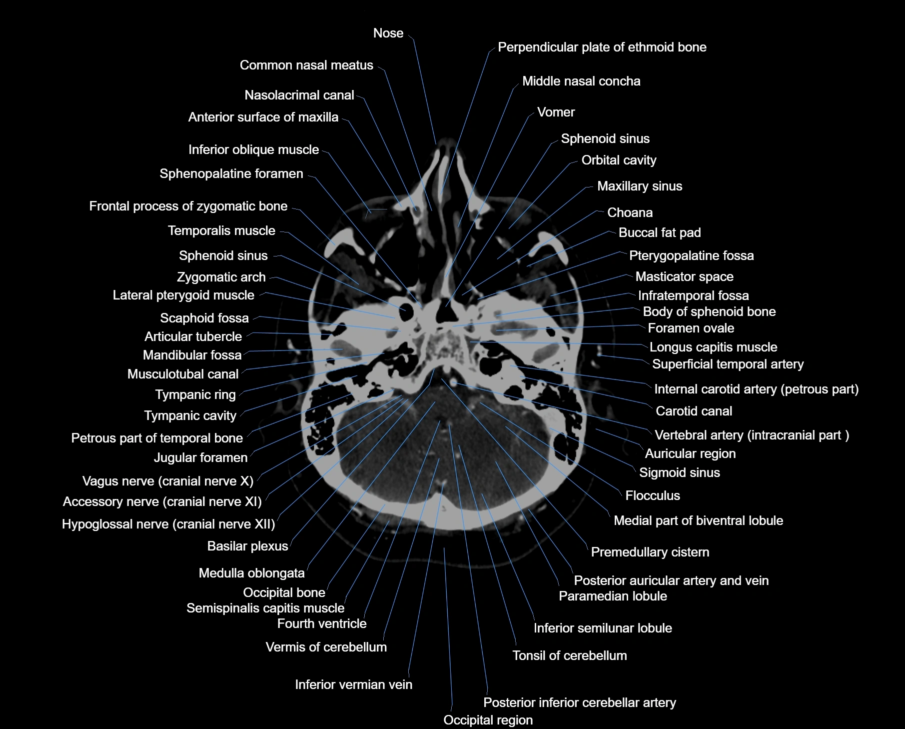 CT scan brain axial labelled cross sectional anatomy image-img-000013.webp